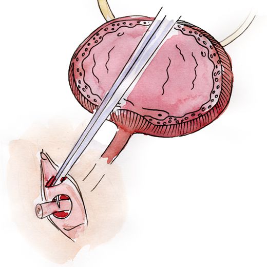 L'urètre détaché est mis dans le tunnel sous-mouqueuse, dans sa place anatomique